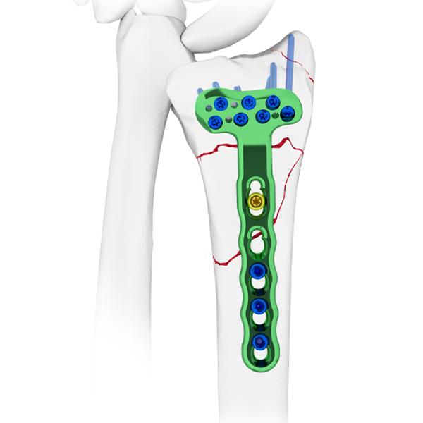 Distal Volar Radial Locking Plate: Advancing Wrist Fracture Treatment