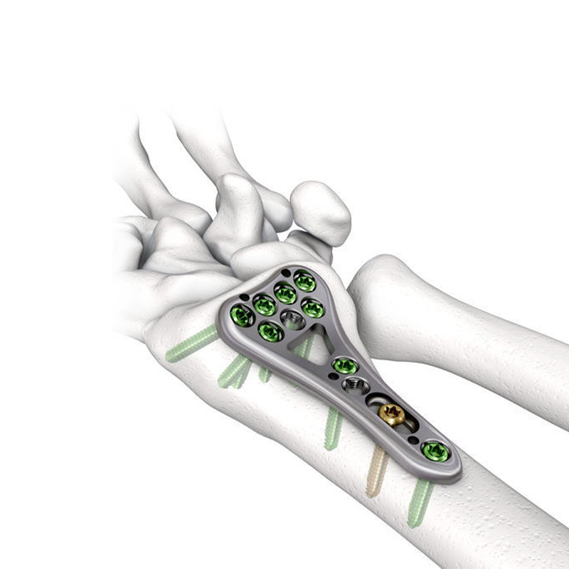 VA Distal Radius Locking Plate: An Advanced Solution for Wrist Fractures