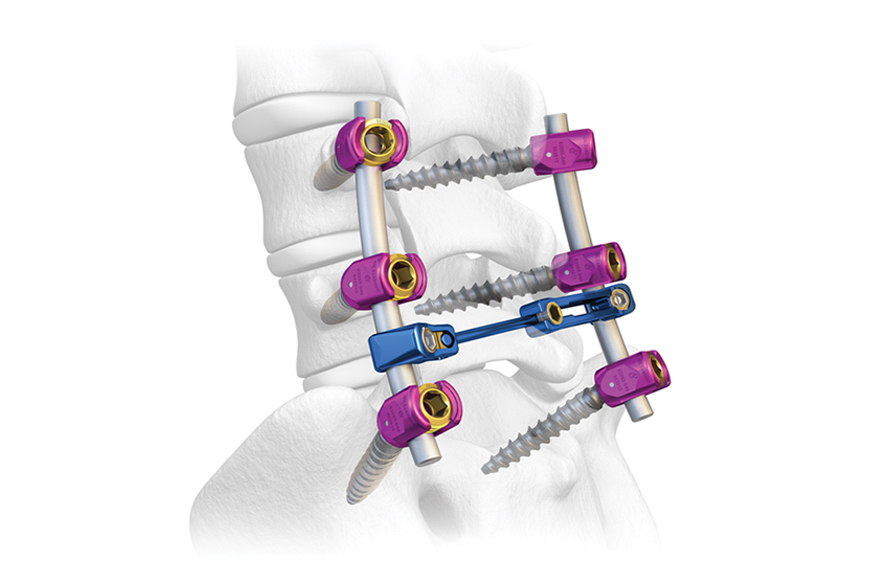 What-is-Spine-Implants