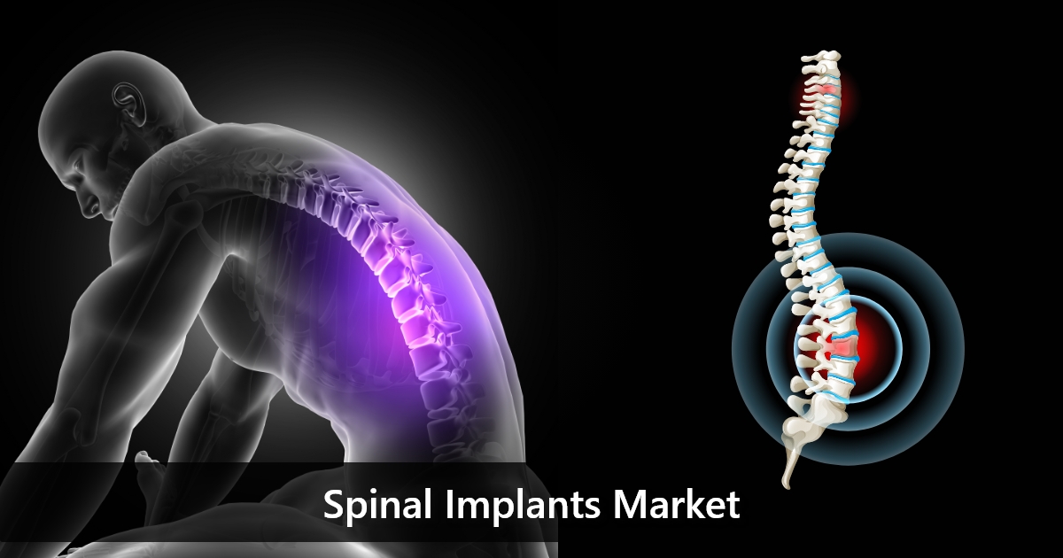 What are spinal implants?