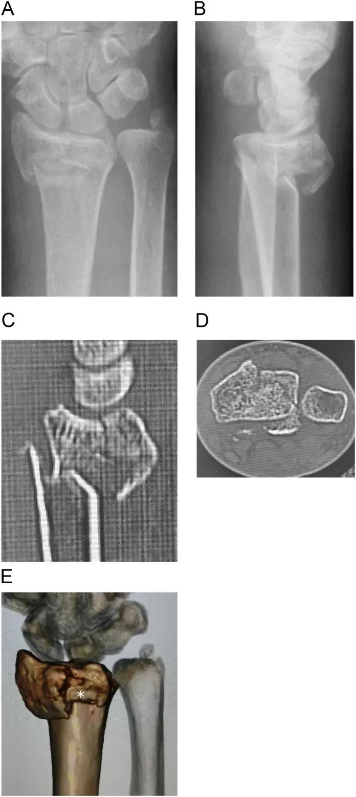 Volar Plate Fixation Czmeditech