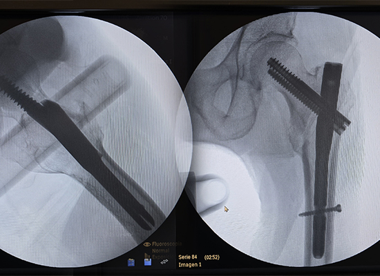 Postoperative X-ray after Intertan Intramedullary Nail fixation of left intertrochanteric fracture-czmeditech Postoperative X-ray after Intertan Intramedullary Nail fixation of left intertrochanteric fracture-czmeditech