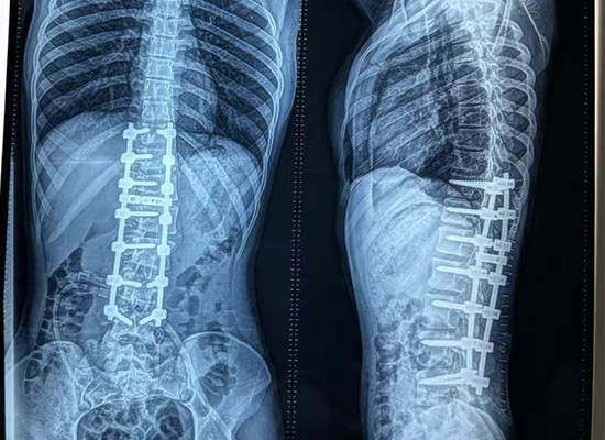 Postoperative X-ray showing corrected spinal alignment after scoliosis surgery in Bangladesh-czmeditech Postoperative X-ray showing corrected spinal alignment after scoliosis surgery in Bangladesh-czmeditech