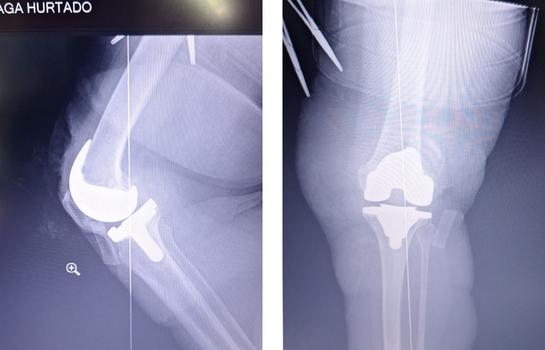 tkr-postoperative-xray-knee-prosthesis