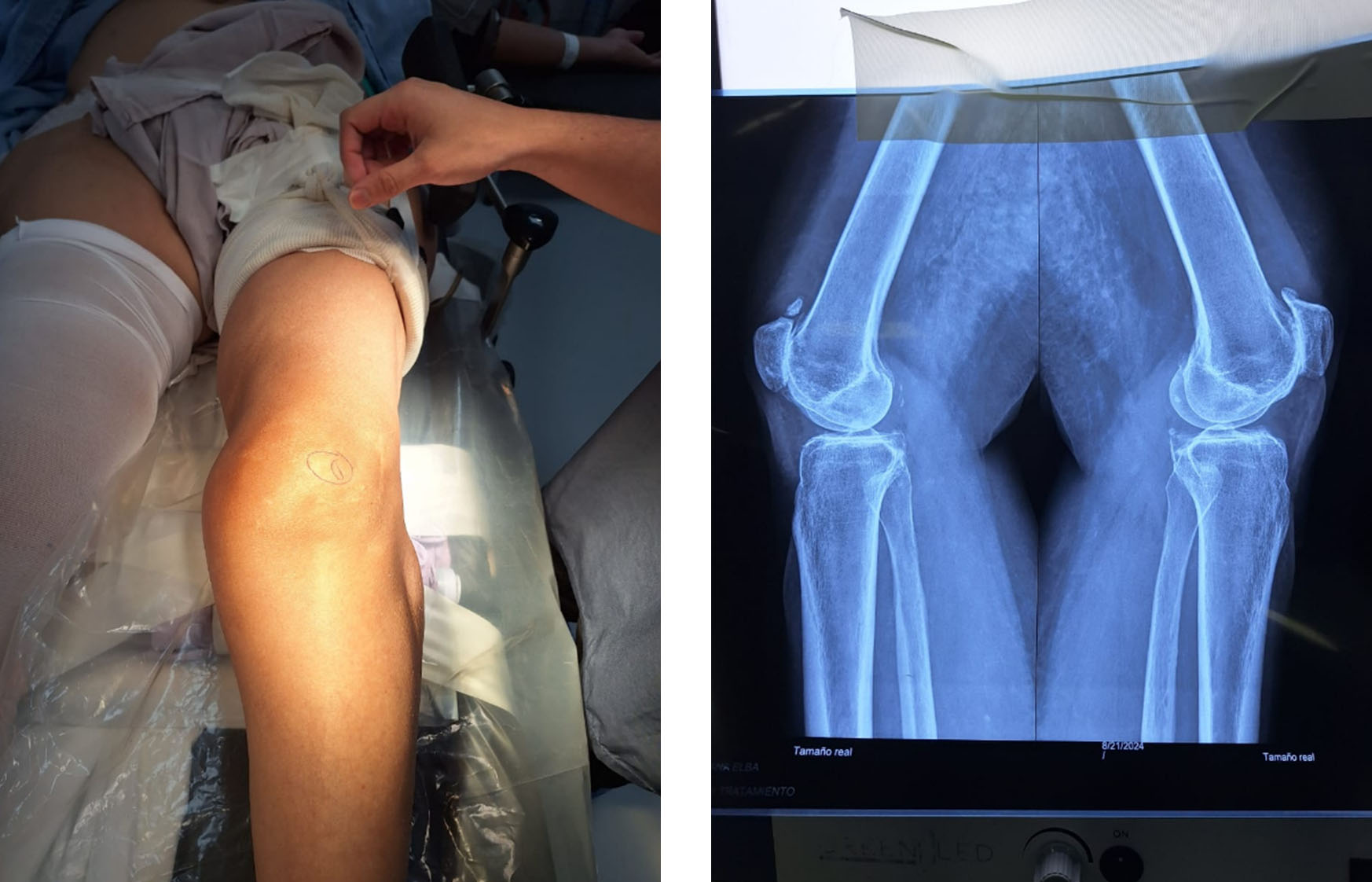 preoperative-knee-swelling-deformity