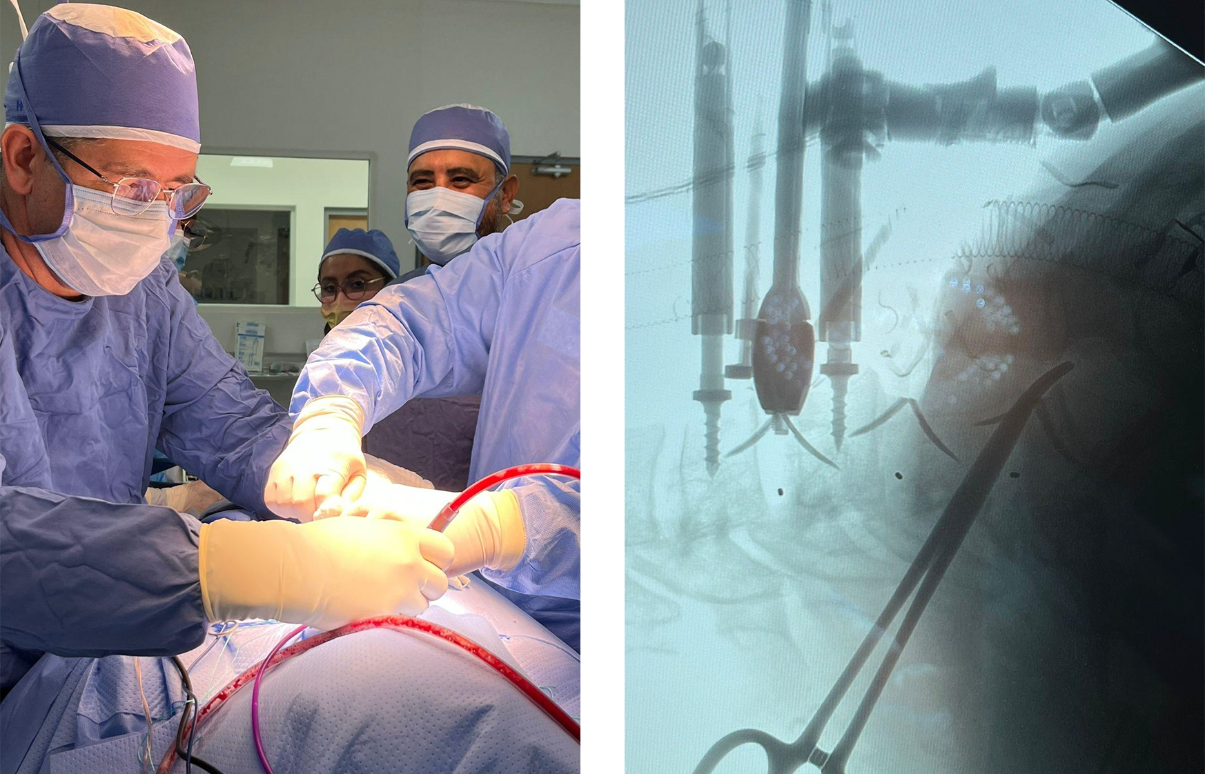 Preoperative cervical disc herniation imaging and Uni-C cage surgery procedure