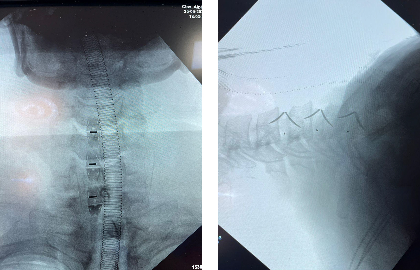 Postoperative cervical X-ray after successful Uni-C Standalone Cervical Cage surgery