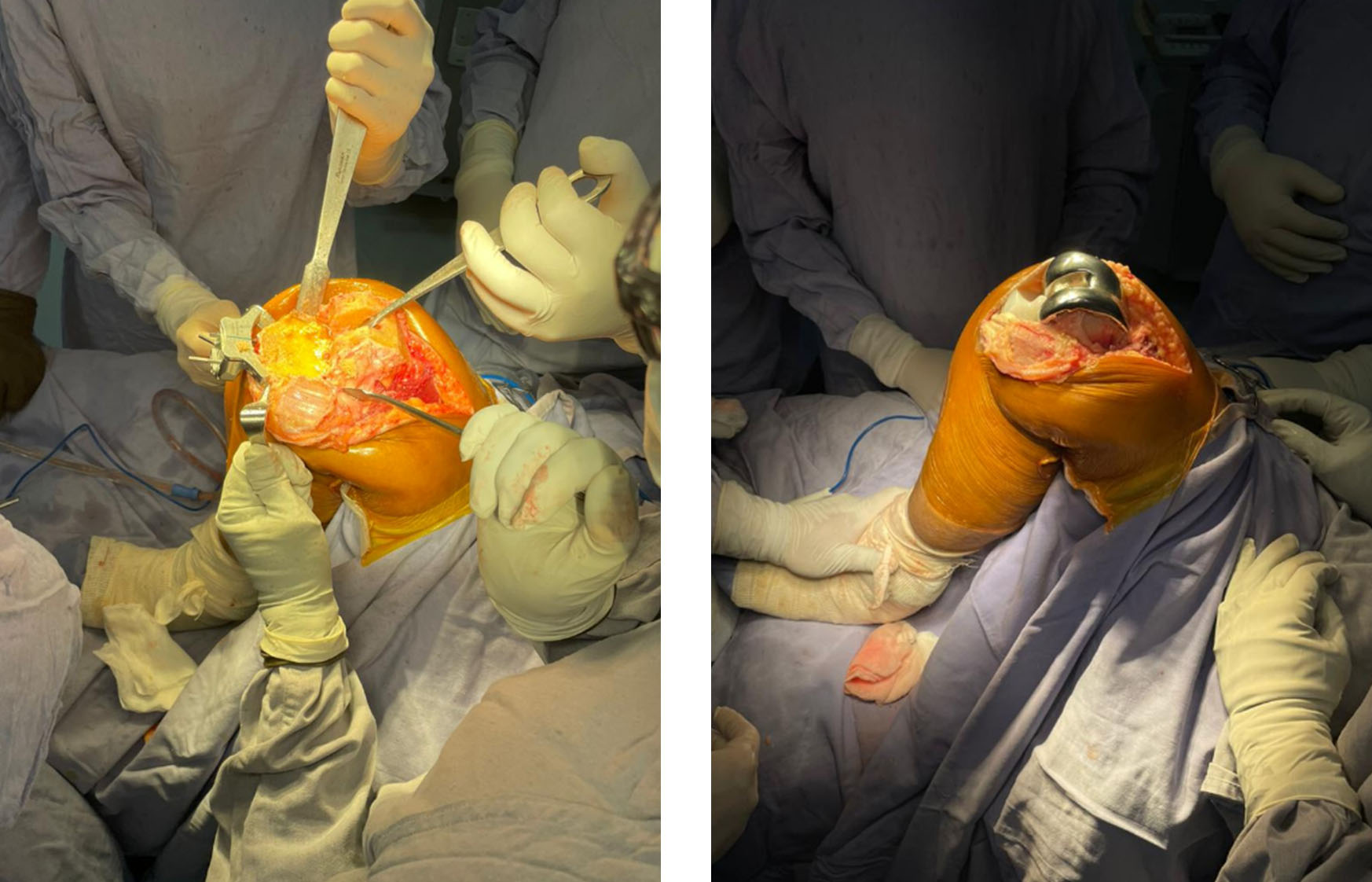 intraoperative-tkr-surgery-implant.