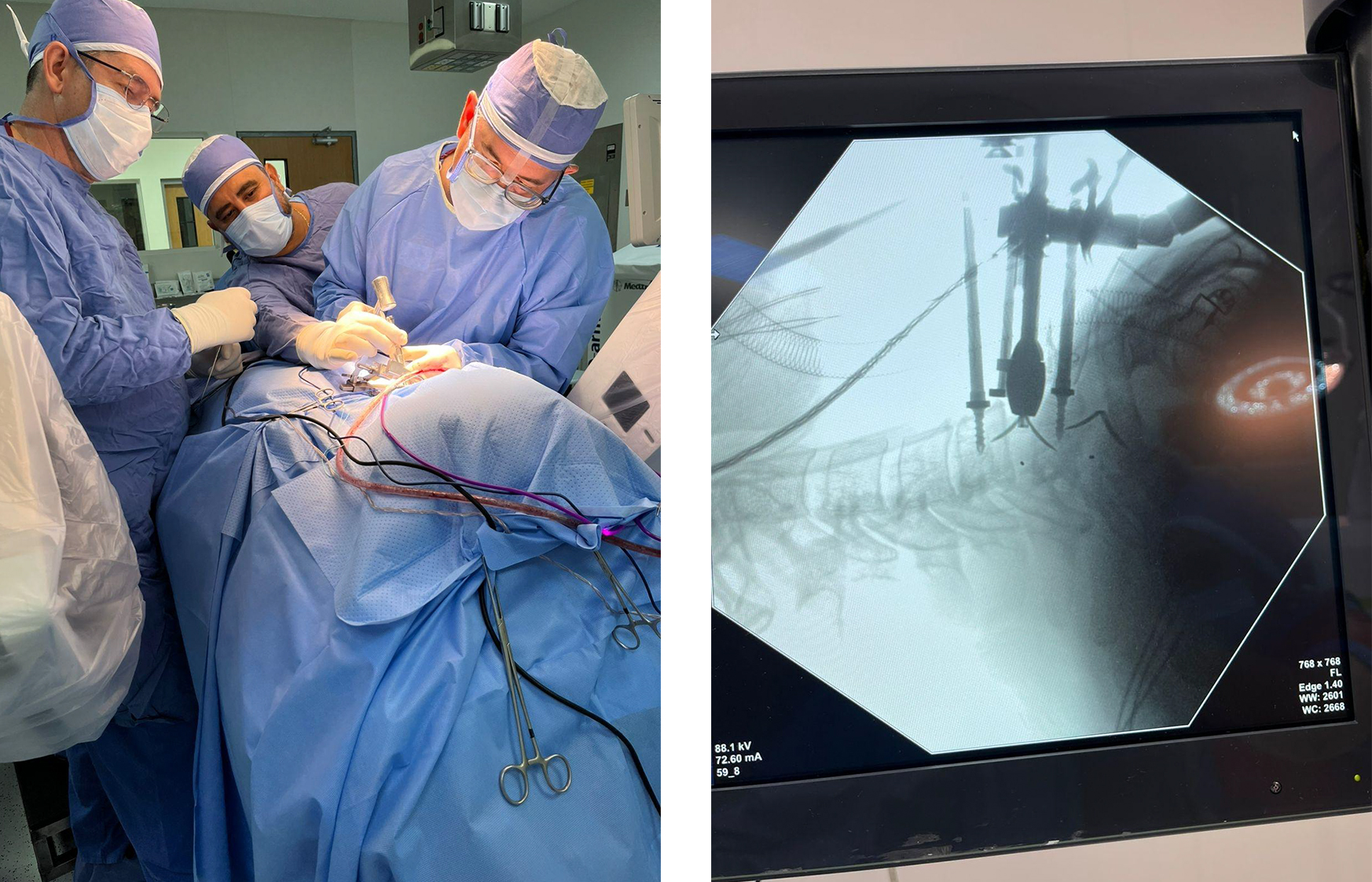 Preoperative cervical disc herniation imaging and Uni-C cage surgery procedure