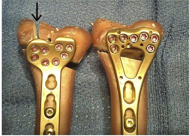 Distal Volar Radial Locking Plate