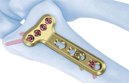 Distal Volar Radius Locking Plate