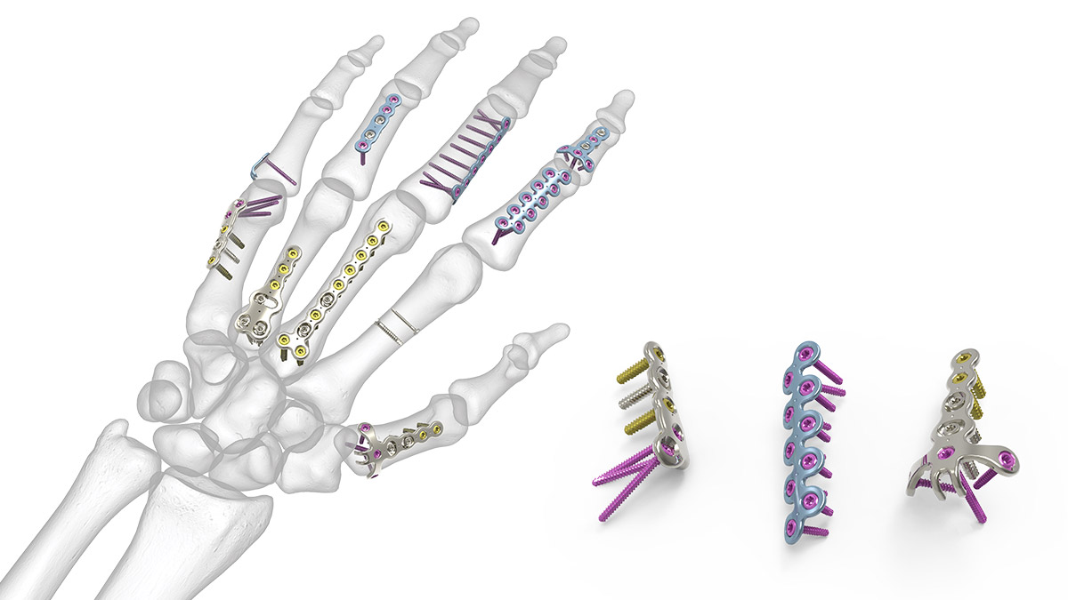 Metacarpal locking plate