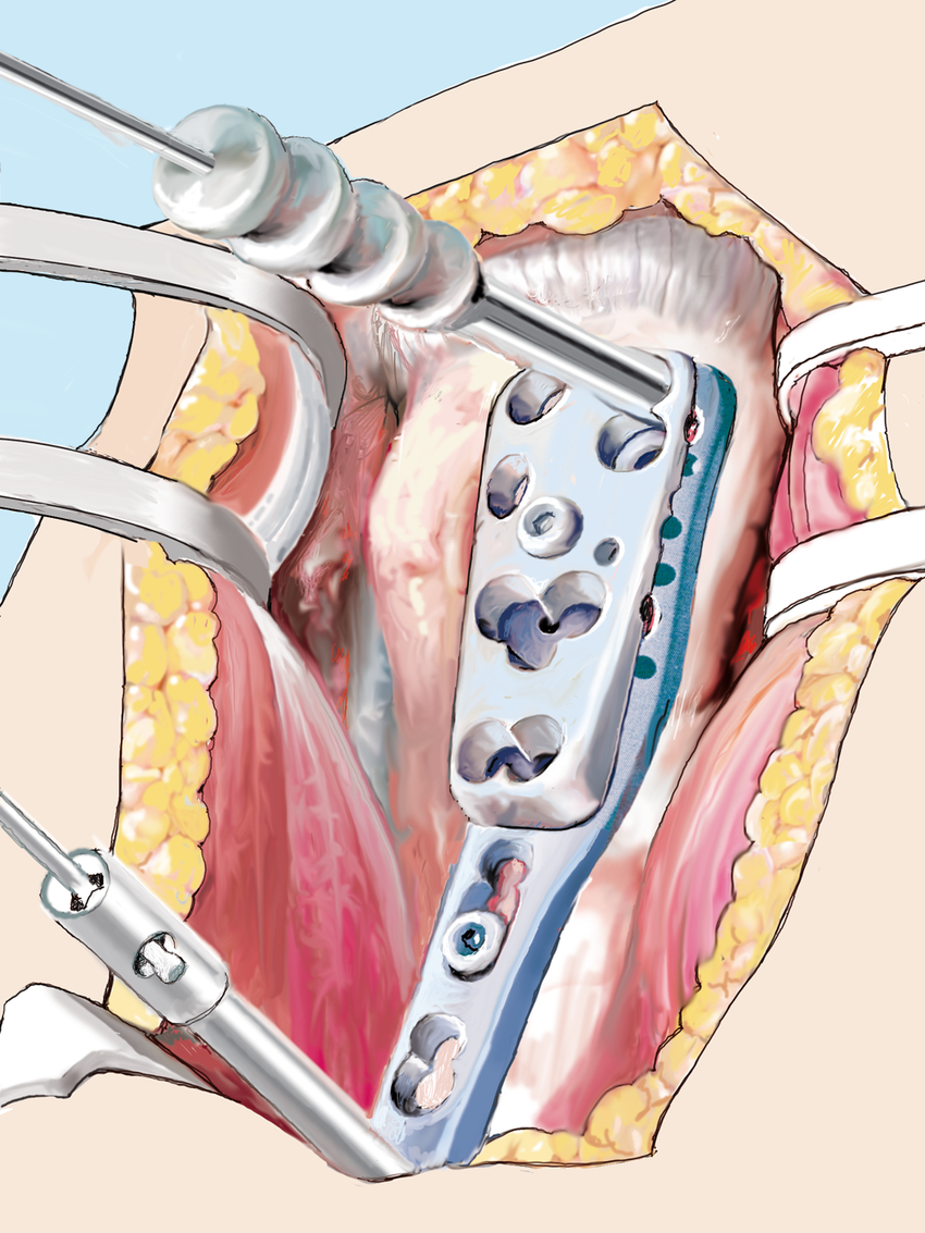 Proximal Humeral Locking Plate
