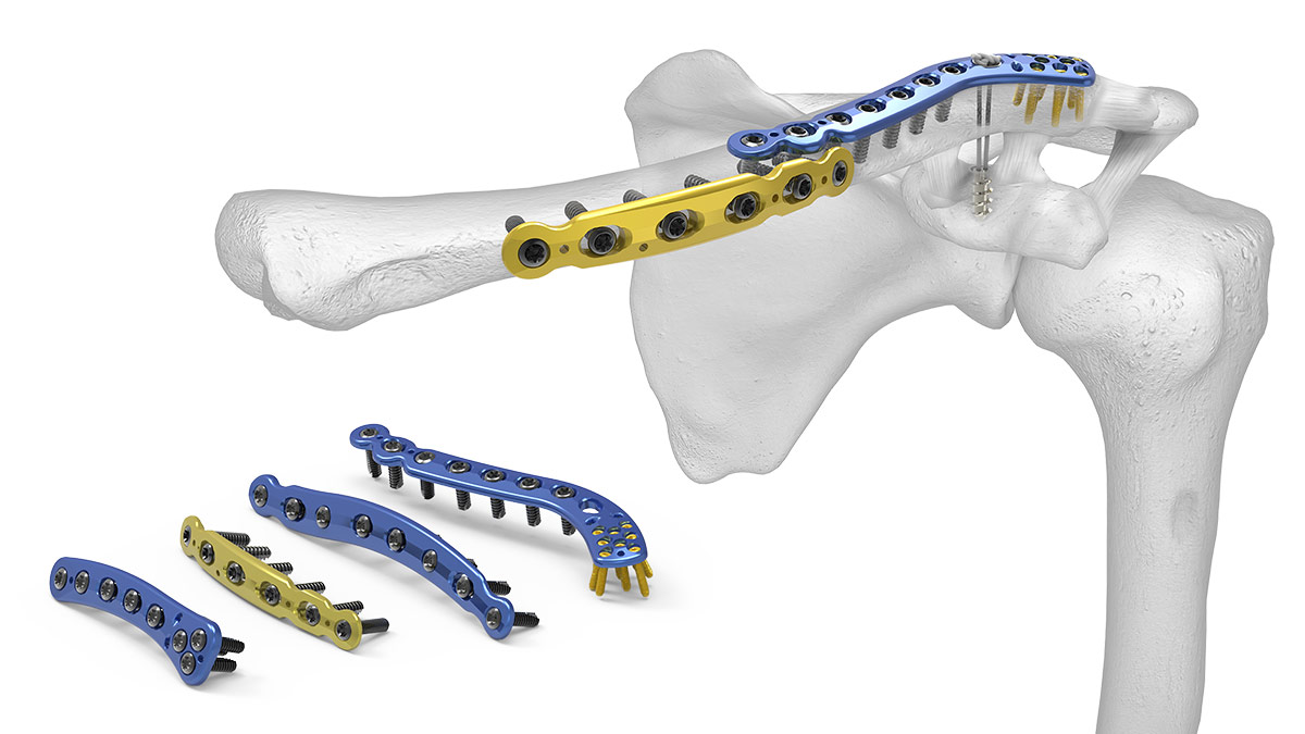 Clavicle Locking Plate