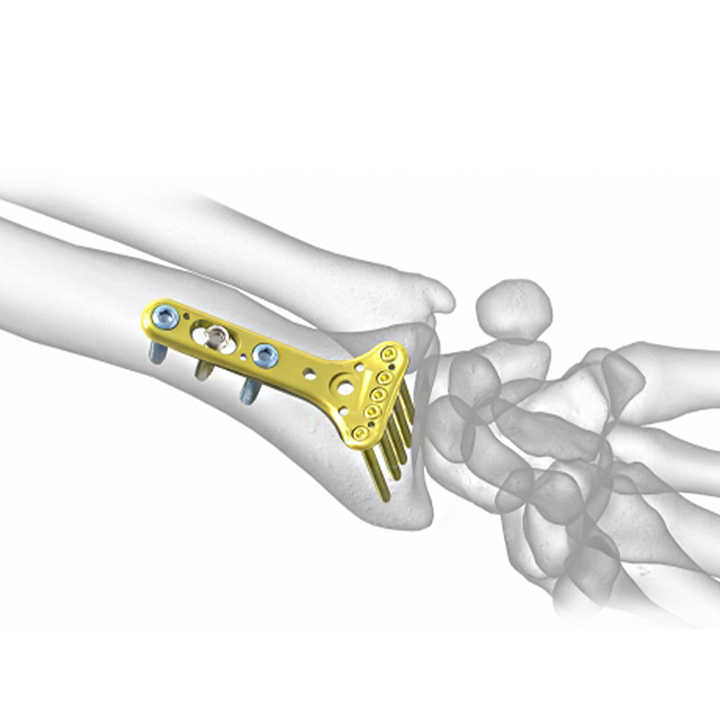 VA Distal Radius Locking Plate