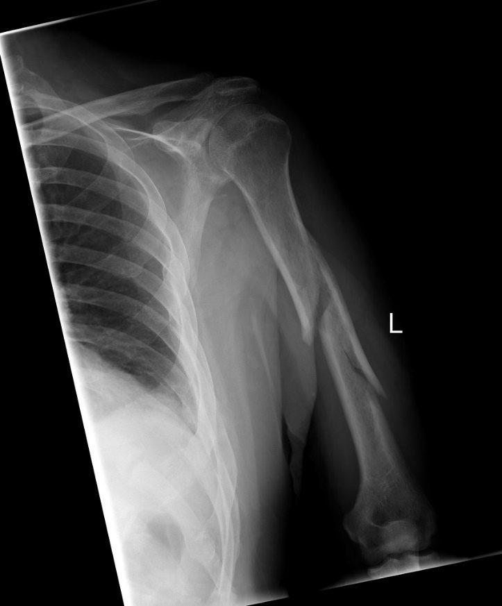 Humeral Shaft Locking Plate