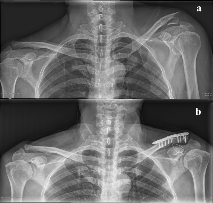 Clavicle Locking Plate