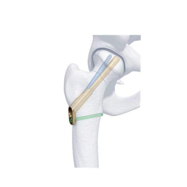 Understanding The Femoral Neck System: A Comprehensive Guide