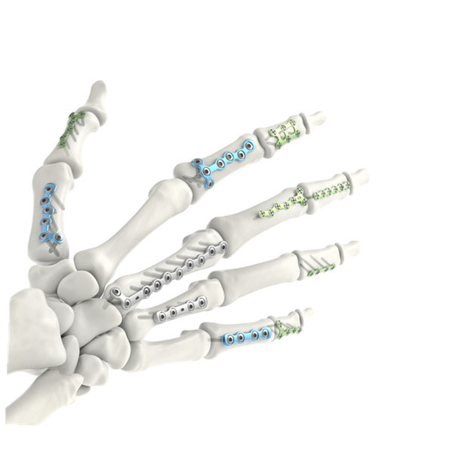Taargooyinka qufulka metacarpal: horumarka daaweynta galka