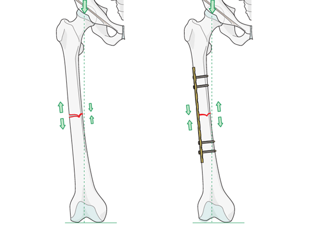 Locking plate fixing