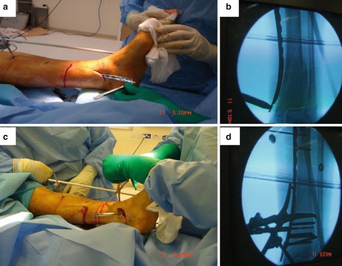 Distal Medial Tibial Locking Plate