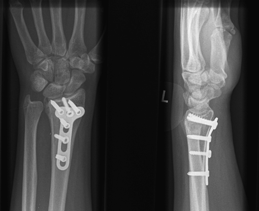 Distal Volar Radial Locking Plate