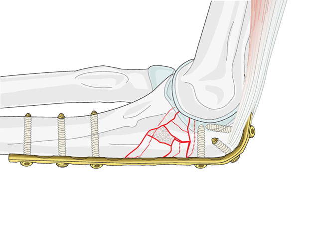 Olecranon Locking Plate: A Revolutionary Solution for Elbow Fractures
