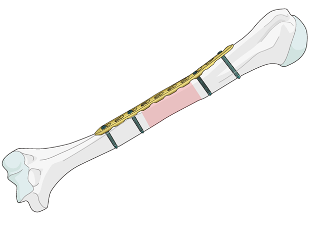 Humeral Shaft Locking Plate