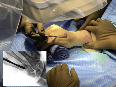 Finger Metacarpal Locking Plate Surgical Procedure