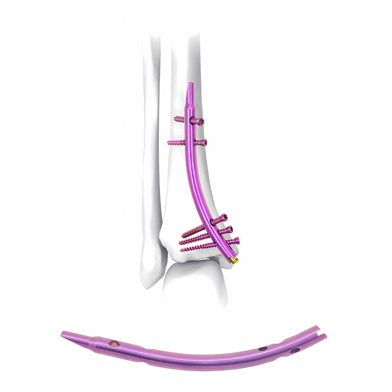 Distal-Tibial--Intramedullary-Nail-(DTN)