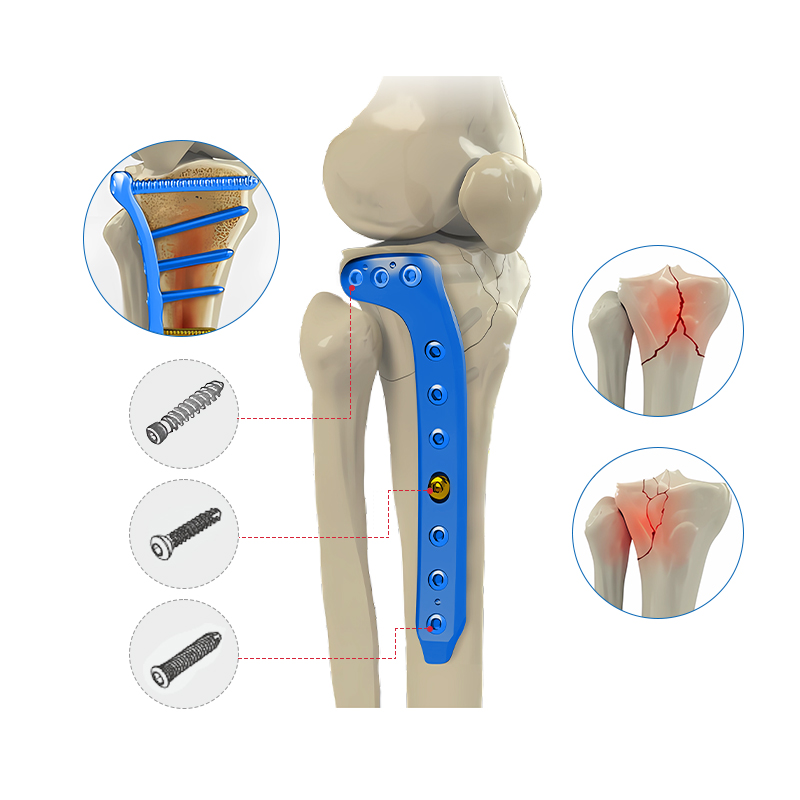 Sahani ya kufunga ya tibial ya tibial