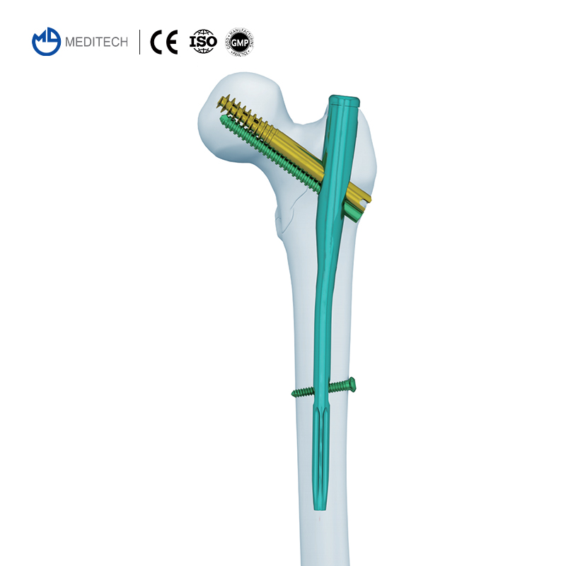 Intertan Intramedullary Nail (1)