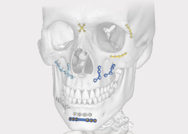 Maxillofacial Plating System