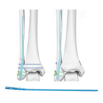 Expert Fibular Intramedullaire nagel