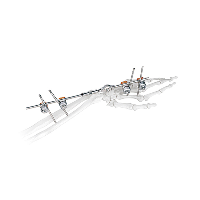 Wrist Joint External Fixator