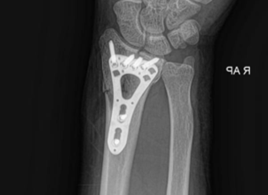 Distal Radius Fracture Surgery in Mexico &mdash; Using CZMEDITECH VA Locking Plate System4