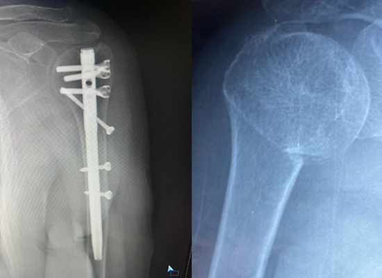 humeral-fracture-postoperative-xray-czmeditech