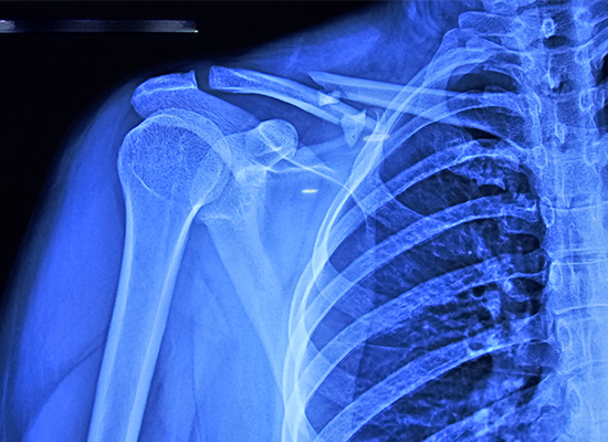 preoperative-clavicle-xray-mexico-case-czmeditech