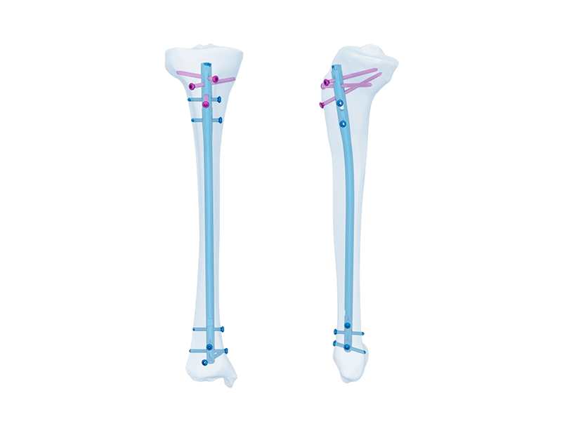 Khabiir ku xeel dheer ciqaabida ciddiyaha: kor u qaadida qalliinka orthopedic