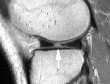 Discontinuous or truncated appearance of the meniscus bowtie on the sagittal image
