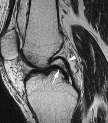 medial meniscus handle