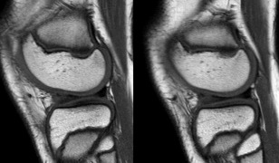 discoid lateral meniscus