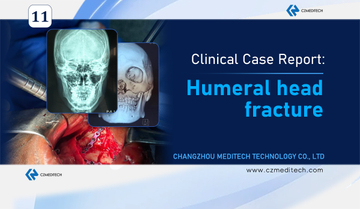 ghana-humeral-head-lefort-fracture-case-study-czmeditech.jpg
