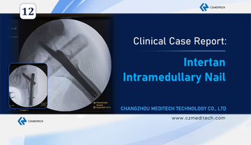 Intertrochanteric fracture case in Lima Peru treated with CZMEDITECH Intertan Intramedullary Nail.jpg