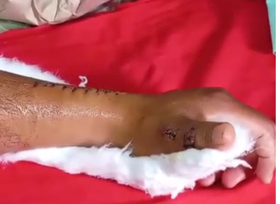 postoperative-rikuperim-thumb-movement-sports-medicine-czmeditech