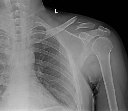 Clavicle fracture