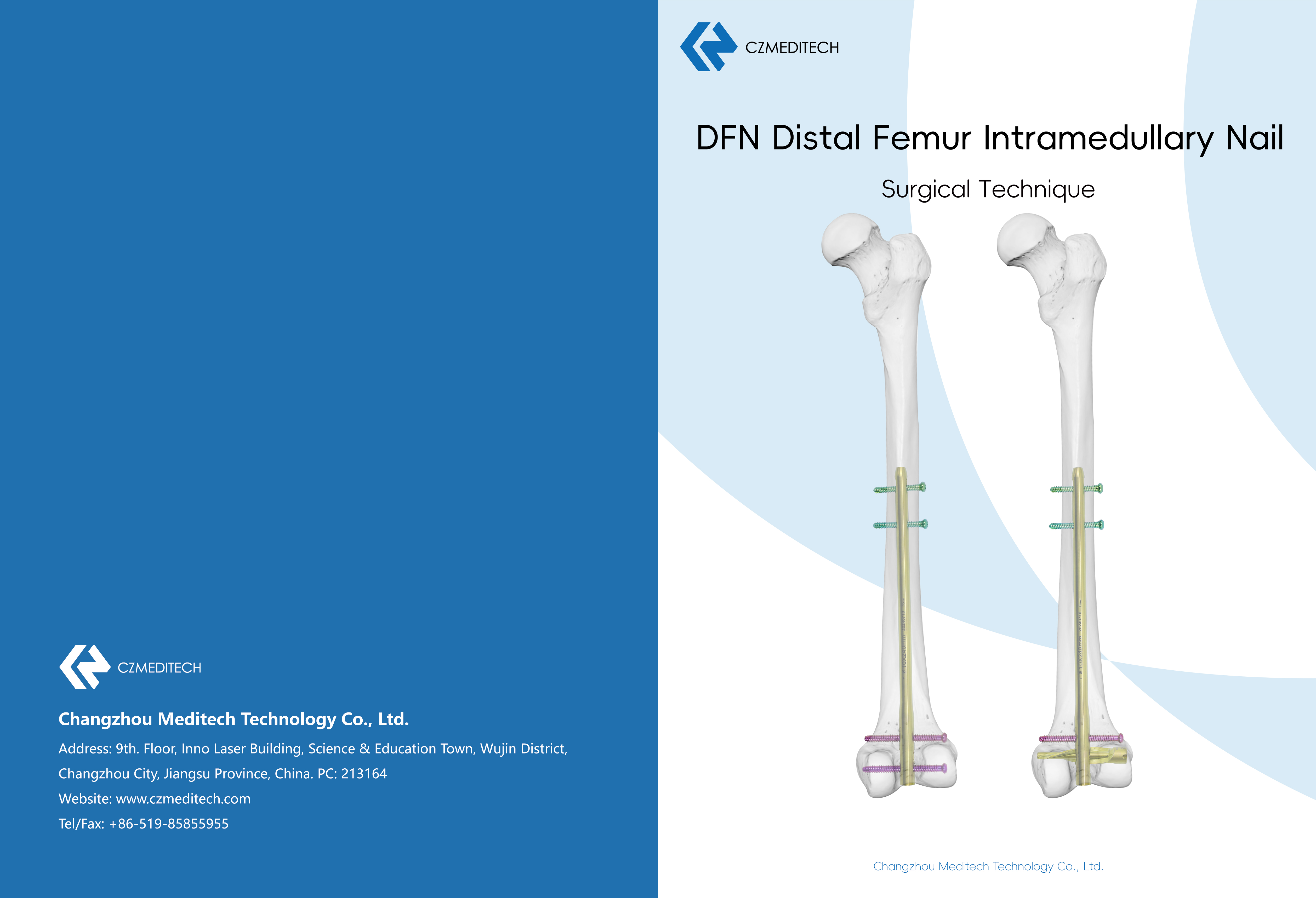 DFN Distal Femur Intramedullary Nail 