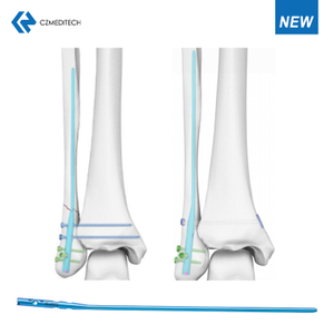 Expert Fibular Intramedullary Nail