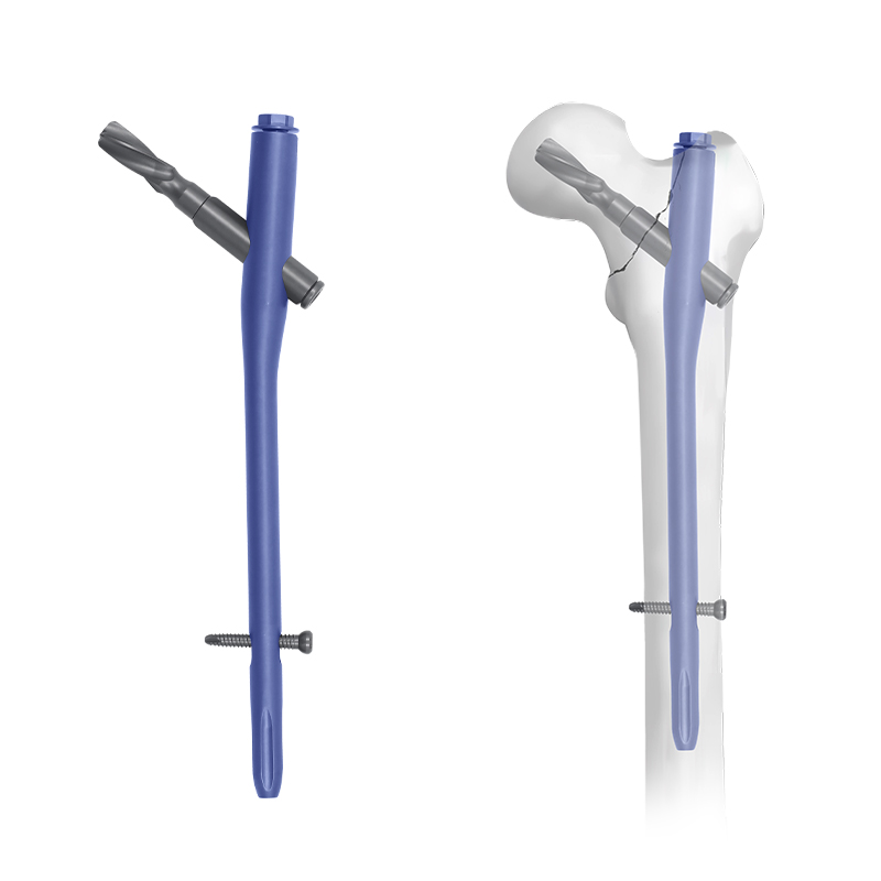 Femoral Neck System