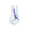 VA Distal Tibia Locking L-Plate